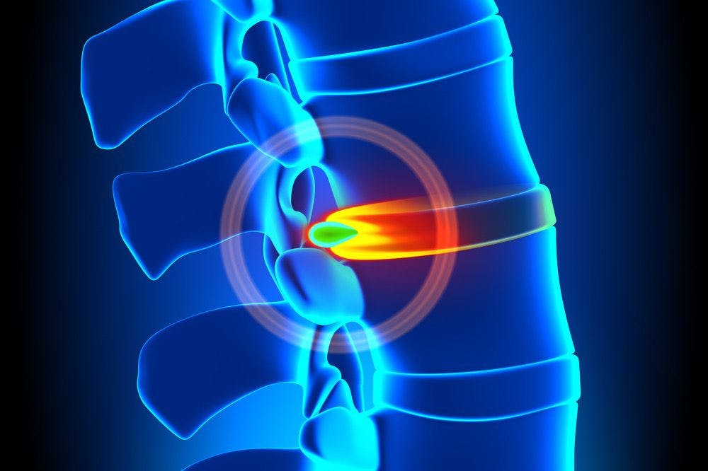 Treatment for Herniated Disc & Types of Treatment